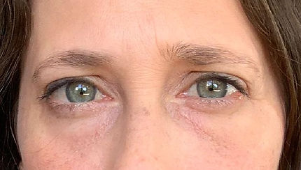 צניחת עפעף מולדת