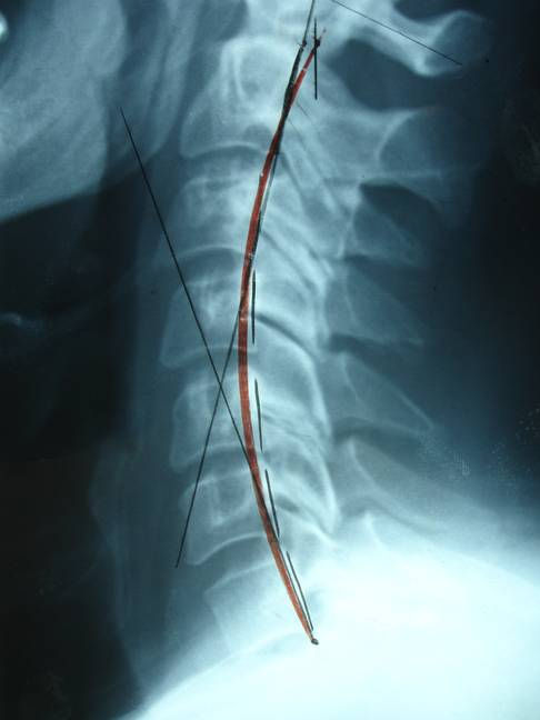 Normal Neck Curve