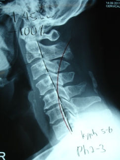 Phase 2 Degeneration of Spine