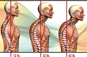 head forward posture causes more pressure on spine example