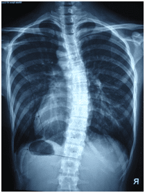 Scoliosis X-ray of Spine