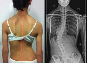 Scoliosis example
