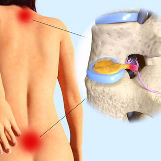 Illustration image of disc problems in neck and lumbar