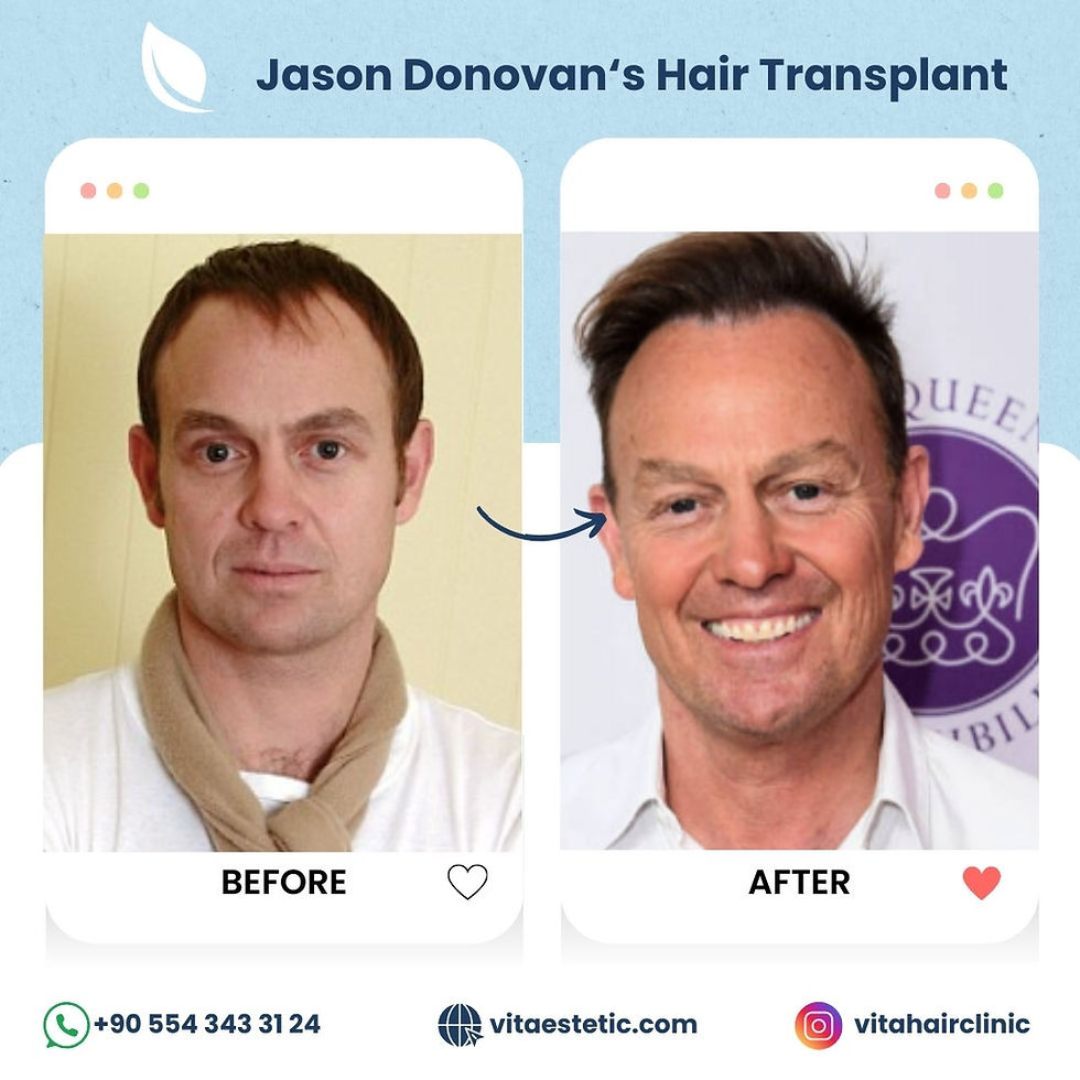 Jason Donovan’s hair transplant