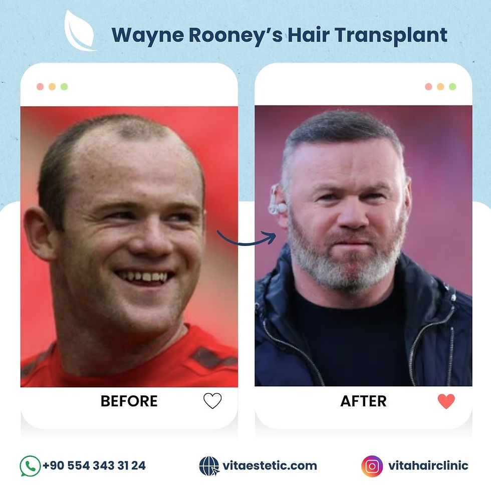 Wayne Rooney's Hair Transplant