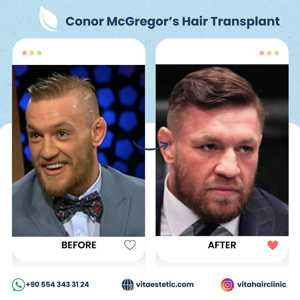 Conor Mcgregor's hair transplant