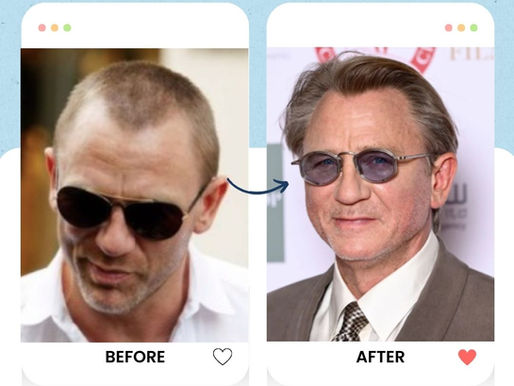Daniel Craig Hair transplant
