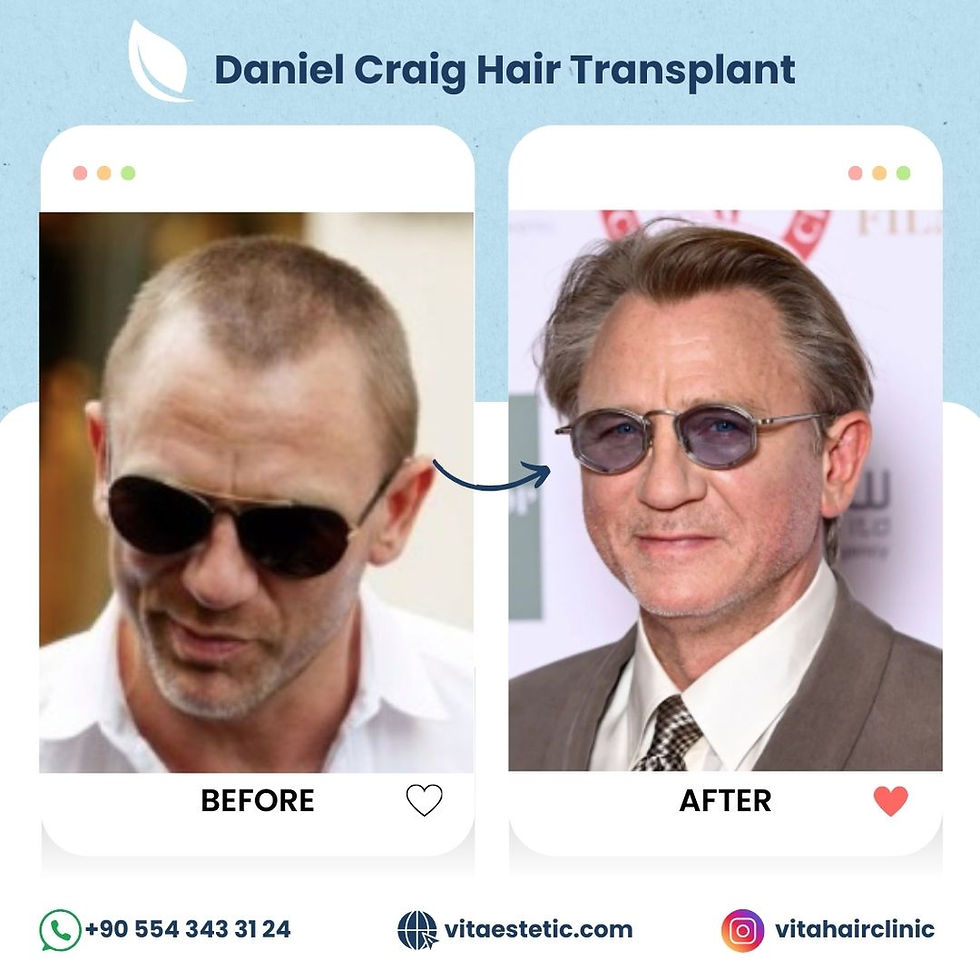 Daniel craig hair transplant