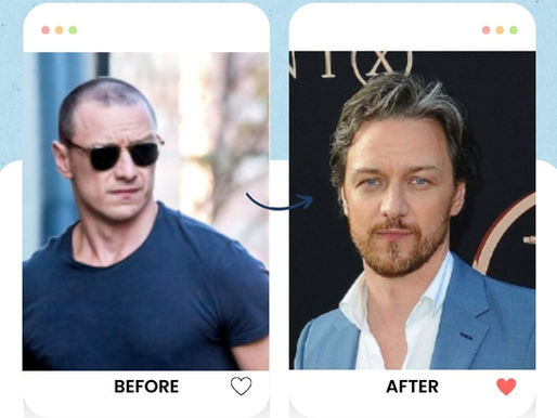 James McAvoy's hair transplant