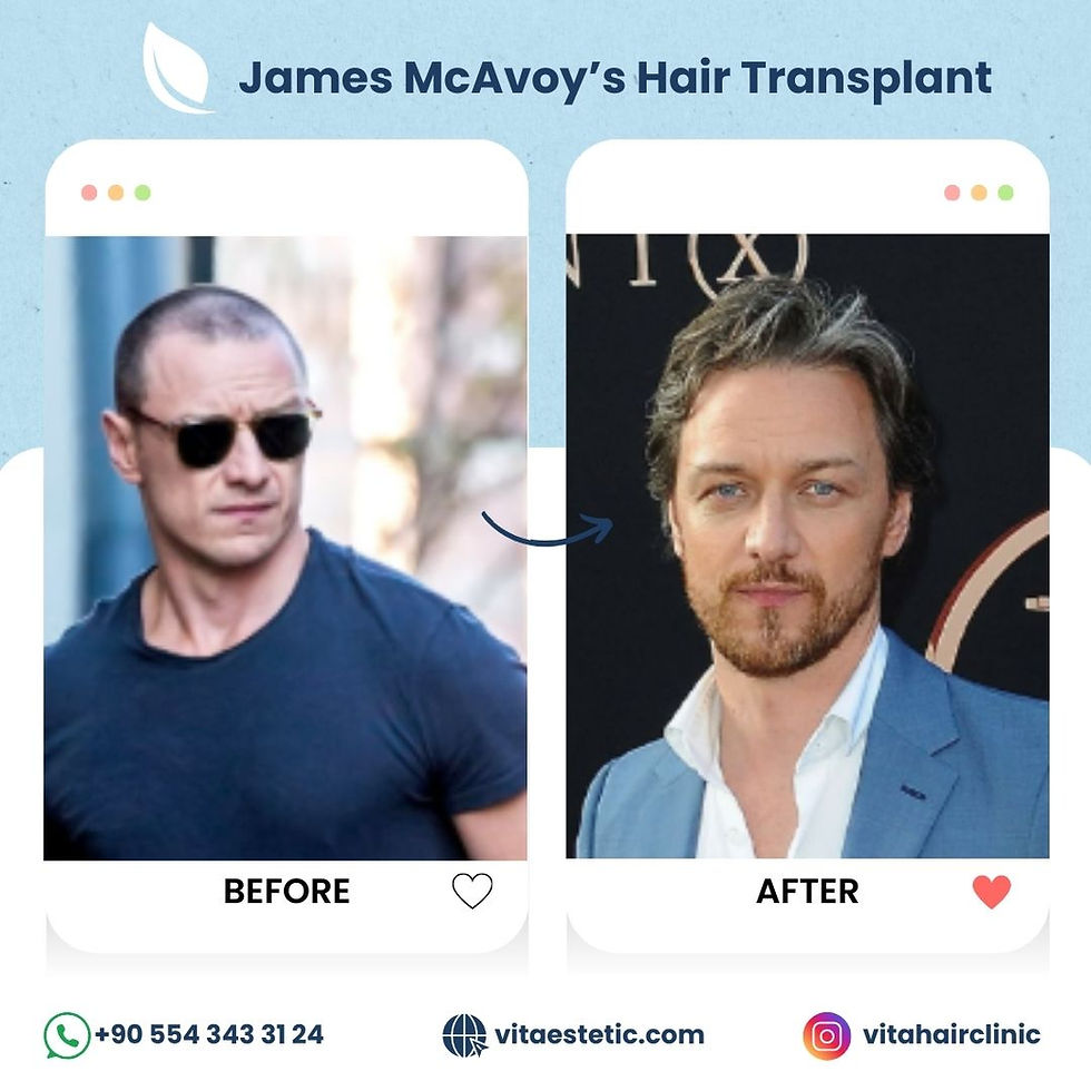 James McAvoy's hair transplant