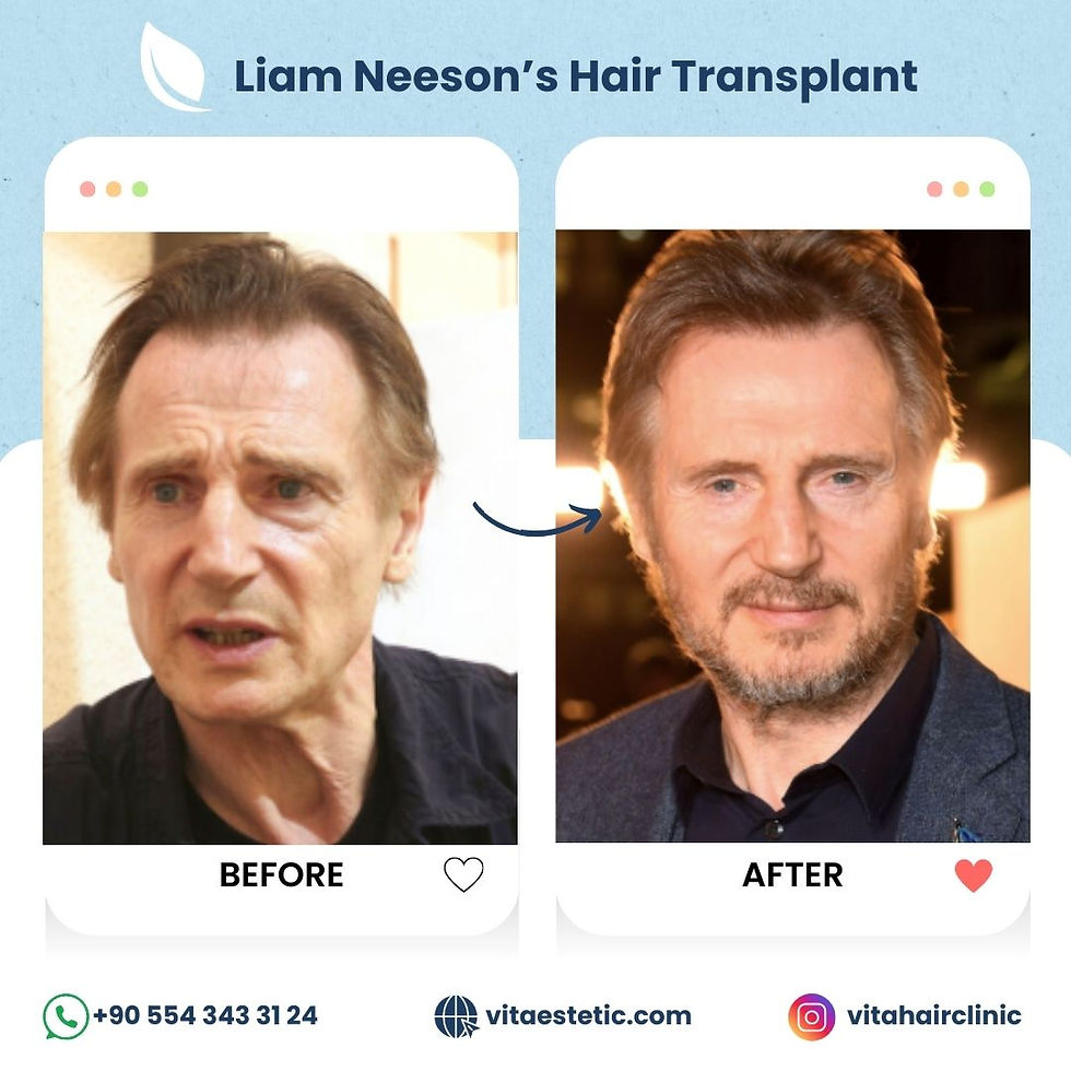 Liam Neeson's hair transplant
