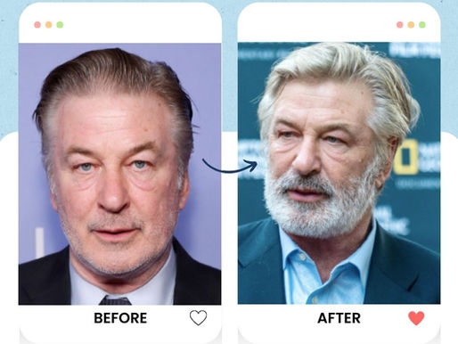 Alec Baldwin Hair Transplant: Restoring Confidence Without Losing Character