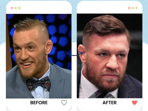 Conor McGregor's hair transplant