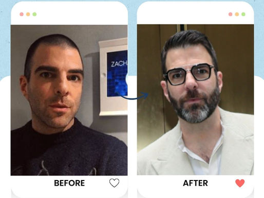 Zachary Quinto Hair transplant
