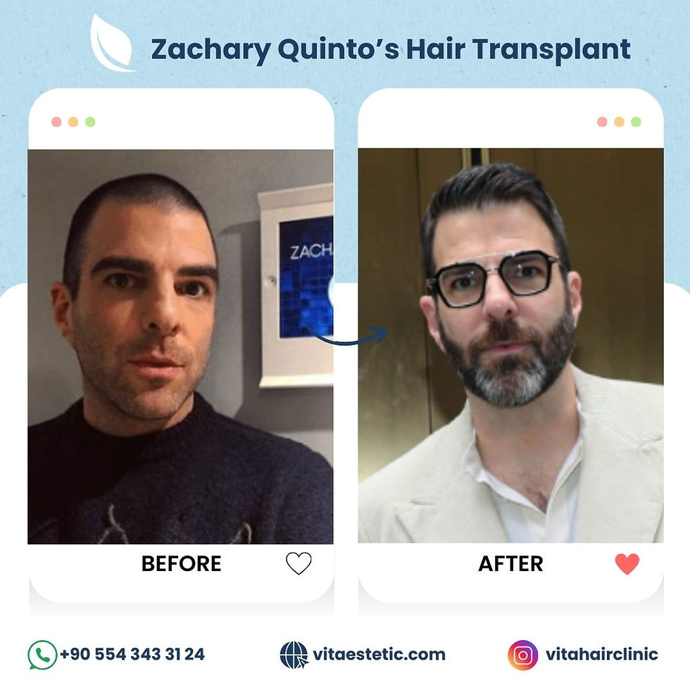 Zachary Quinto Hair transplant