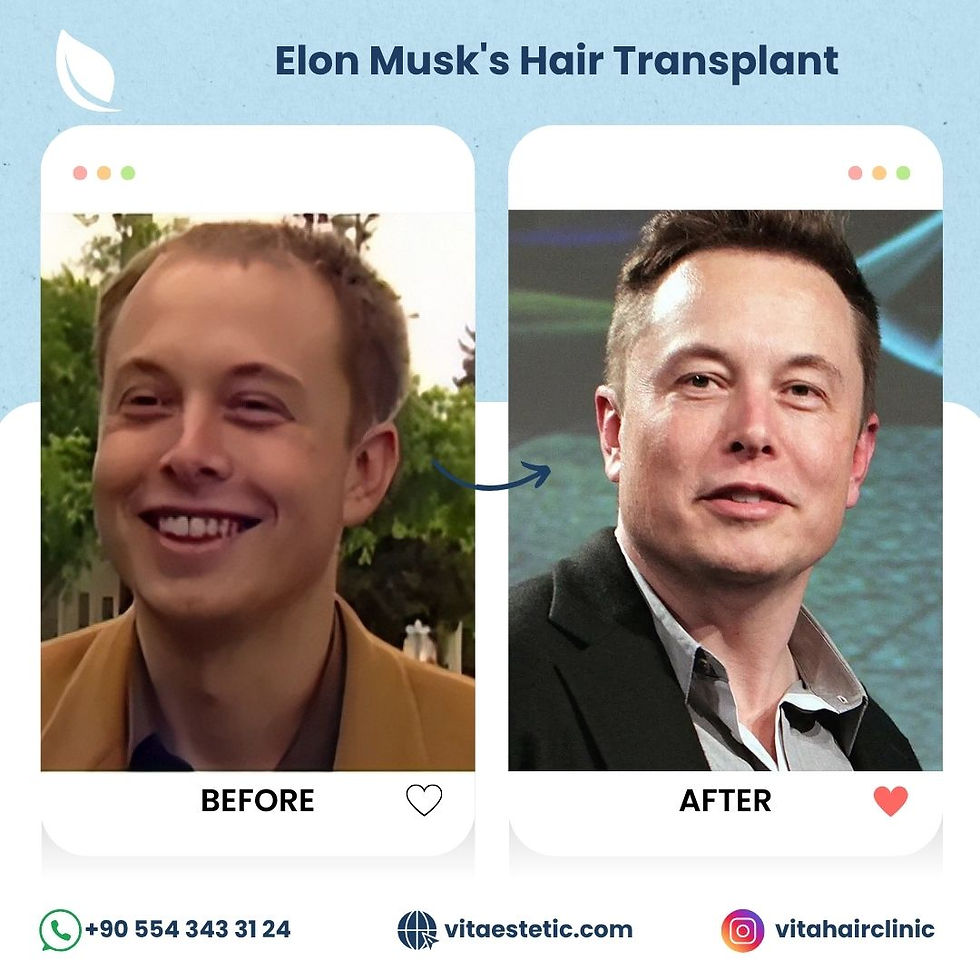 Elon Musk's Hair transplant