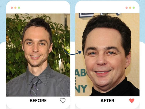 Jim Parsons Hair transplant 
