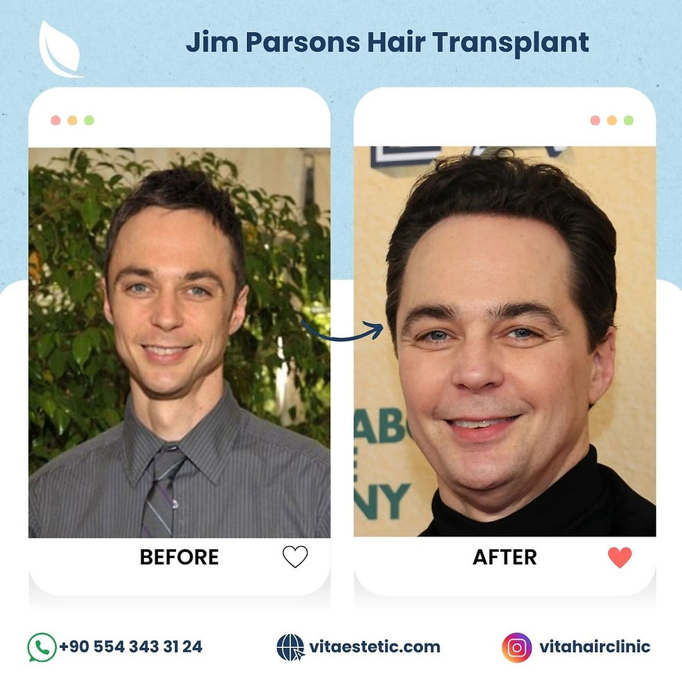 Jim Parsons Hair transplant