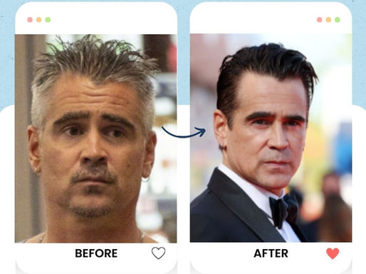 Colin Farell's hair transplant