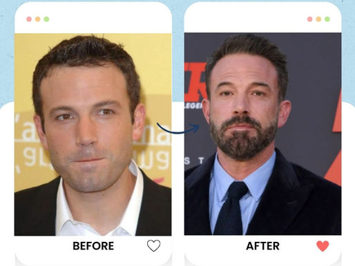 ben affleck's hair transplant
