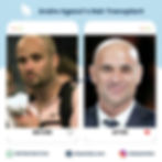 Andre Agassi's hair transplant