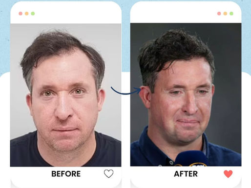 Robbie Fowler's hair transplant