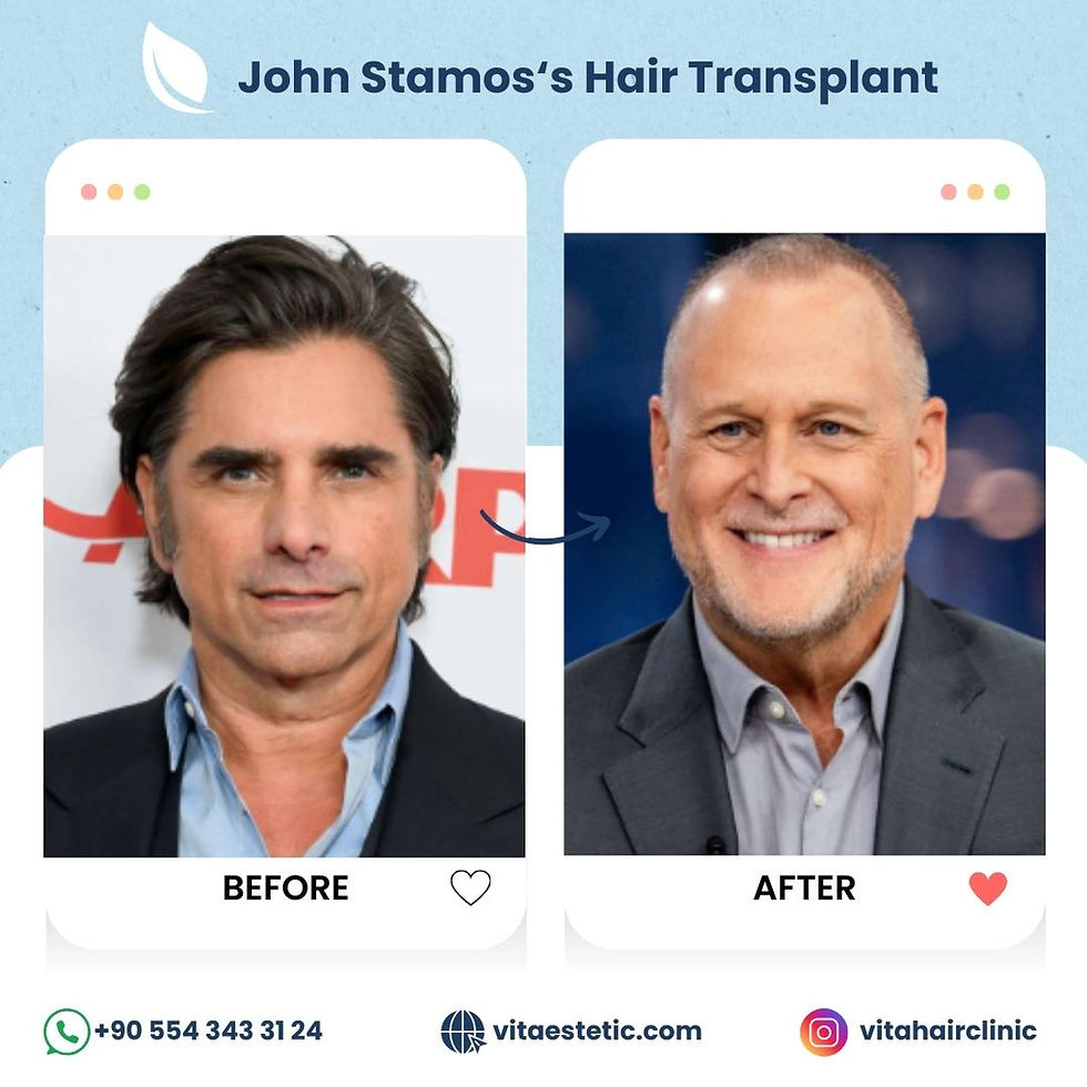 John Stamos hair transplant