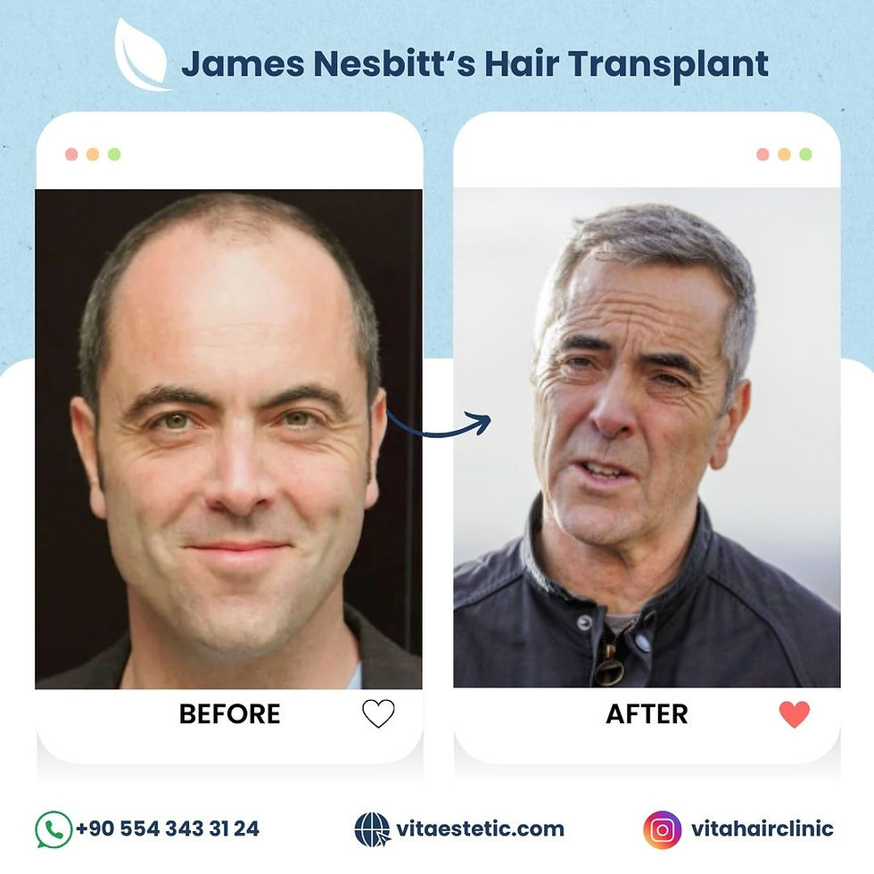 James Nesbitt Hair Transplant