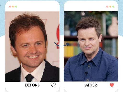 Declan Donnelly's Hair Transplant