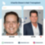 Charlie Sheen's Hair transplant