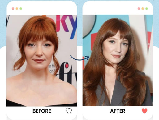 Nicola Roberts's hair transplant