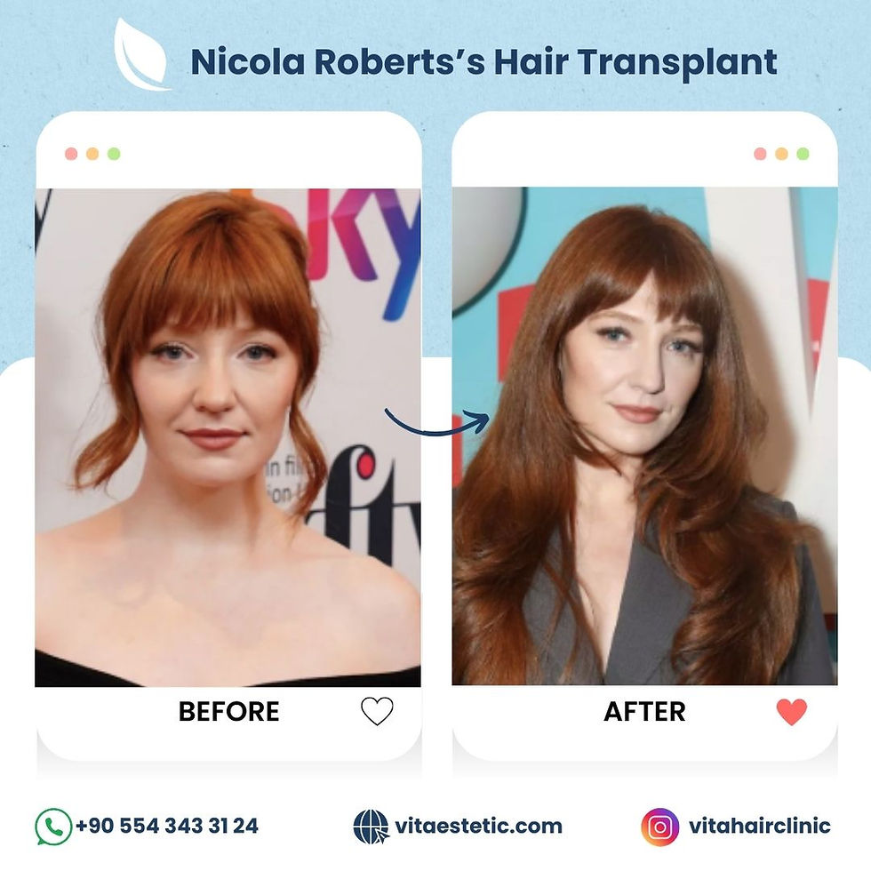 Nicola Roberts's hair transplant