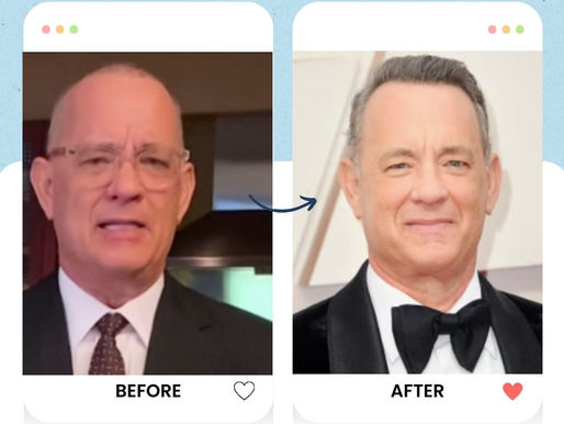 Tom Hanks hair transplant