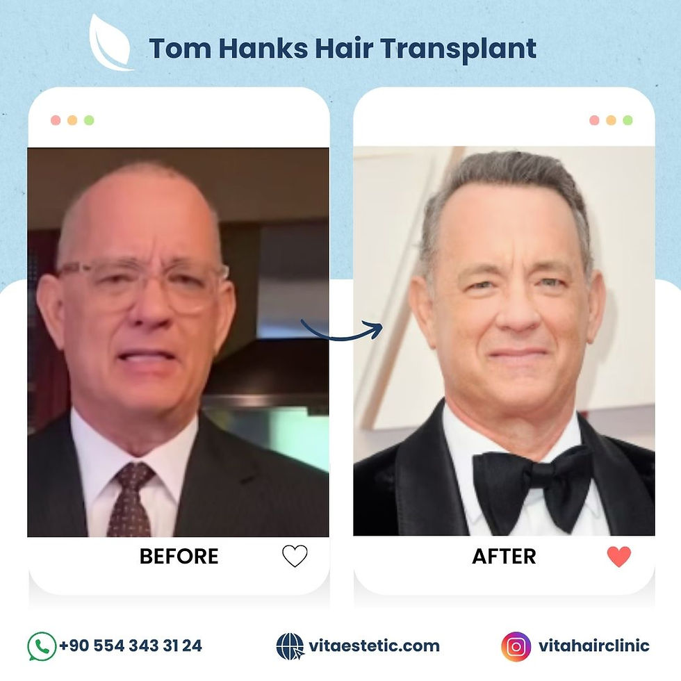 Tom Hanks hair transplant