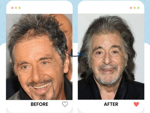 Al Pacino Hair Transplant