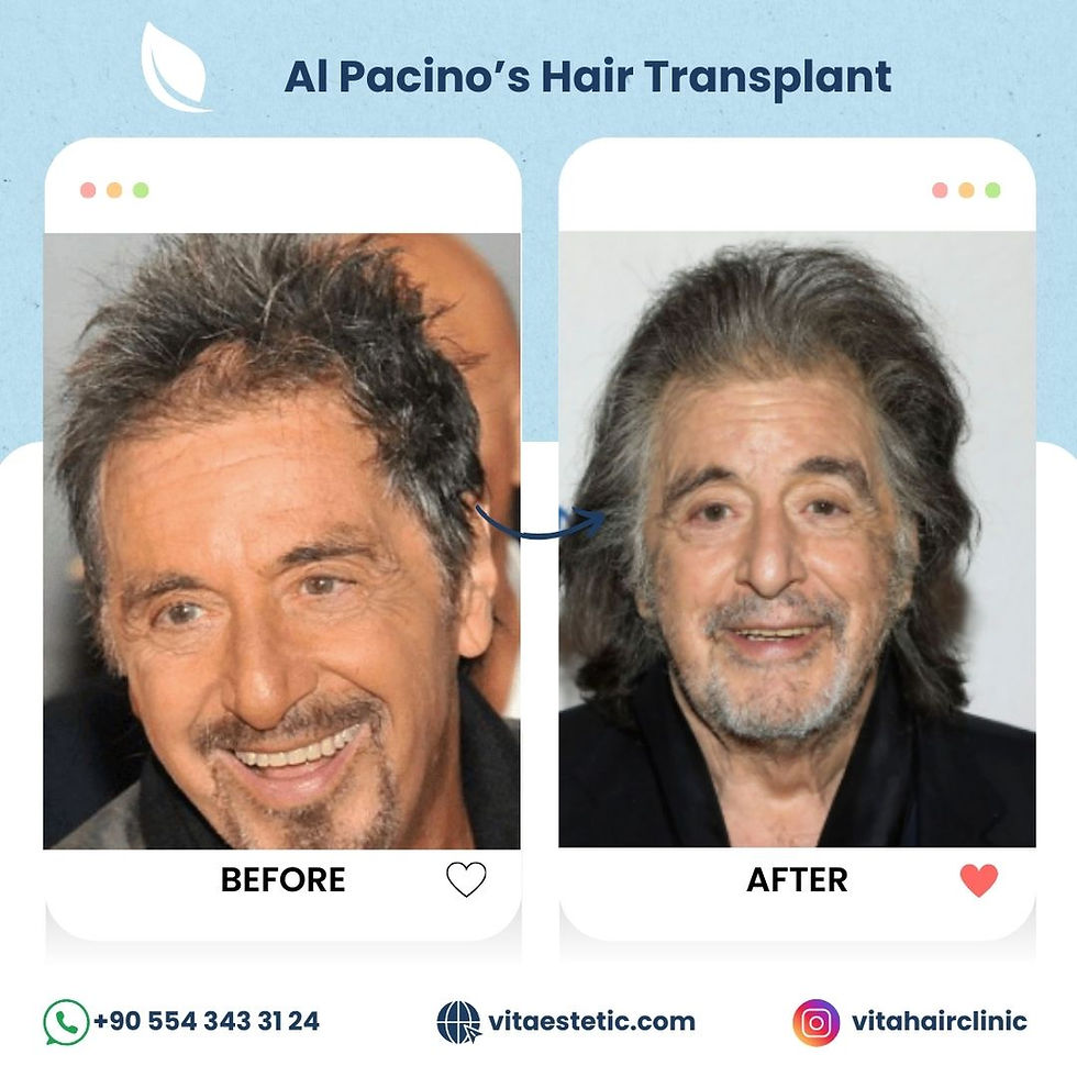 al pacino's hair transplant