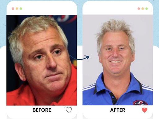 Robbie Fleck's hair transplant