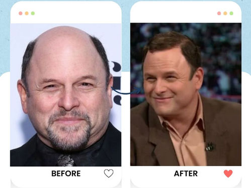 Jason Alexander's hair transplant