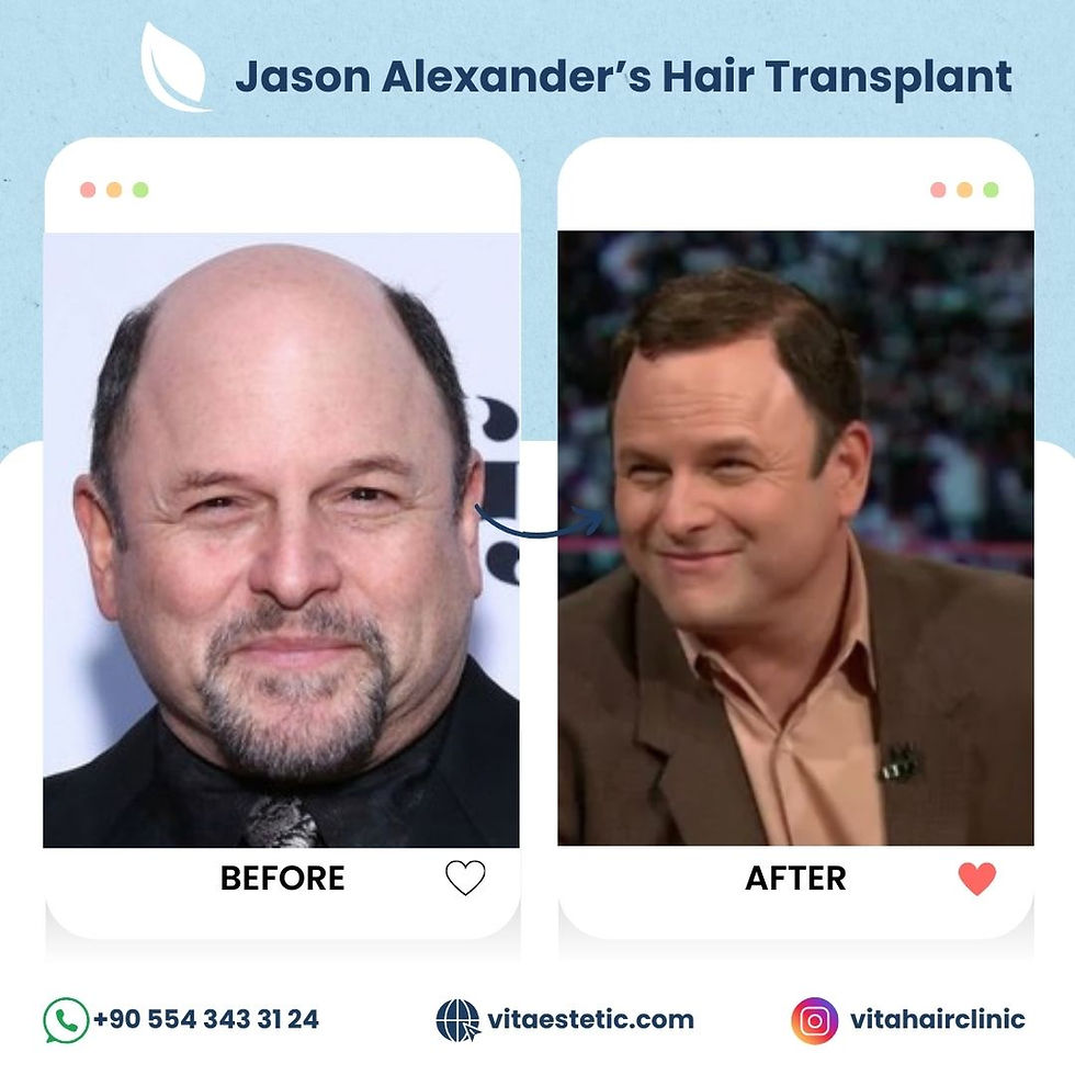 Jason Alexander hair transplant