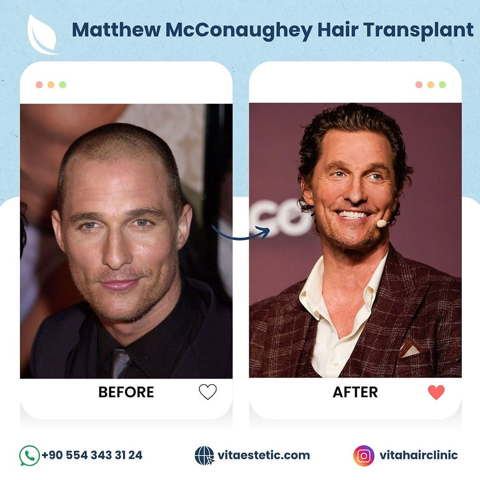 Matthew Mc Conaughey Hair transplant