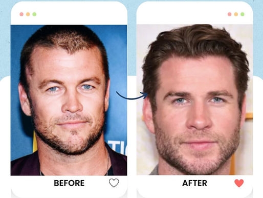 Liam Hemsworth Hair Transplant: Rumor or Reality?