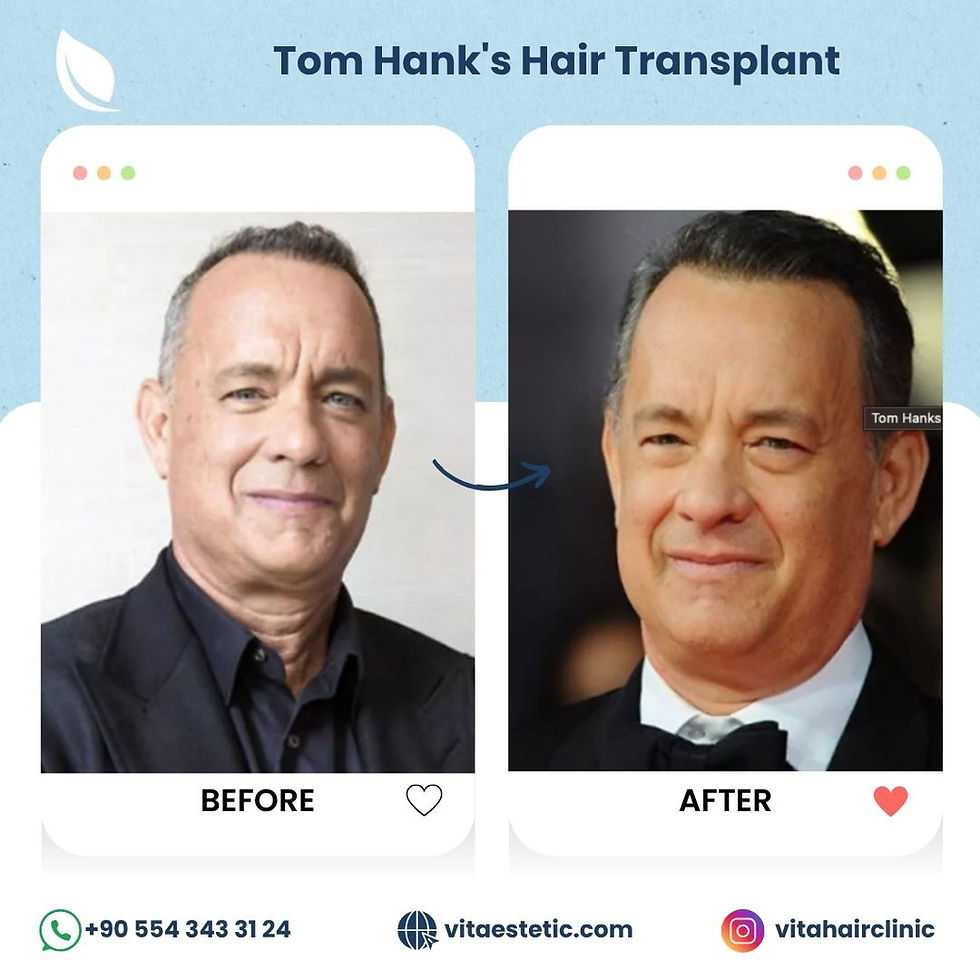 Tom Hanks Hair Transplant
