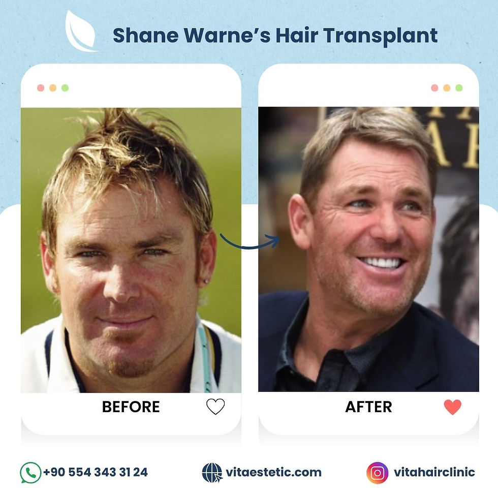 Shane Warne's Hair transplant