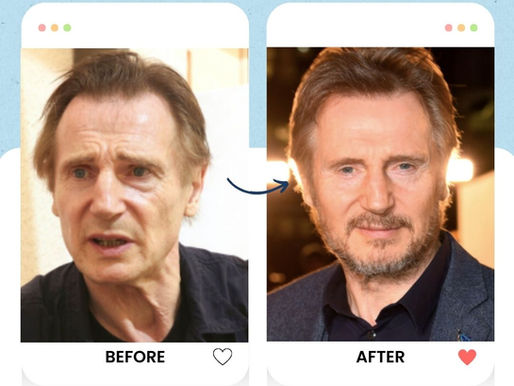Liam Neeson Hair translant