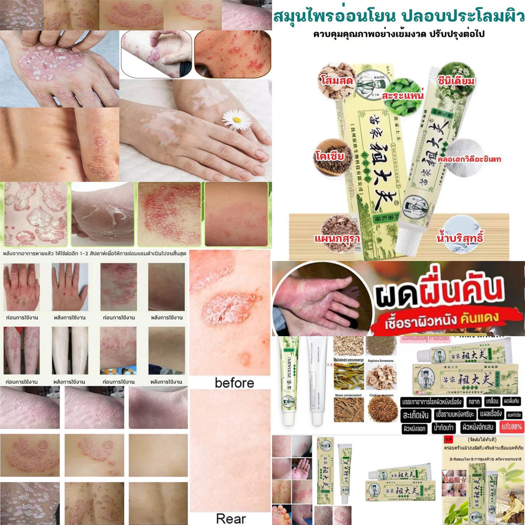 สมุนไพรจีนยาแก้คันBKครีม4หลอด300บาท