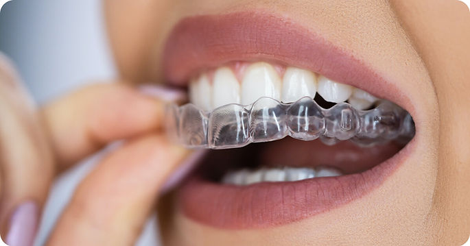 654b181472aae12be85debcf_sorriso-perfeito-invisalign-1200x630.jpg