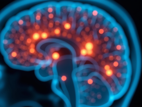 Illustration of brain activity after a concussion showing neurological changes linked to mental health symptoms like anxiety and depression.