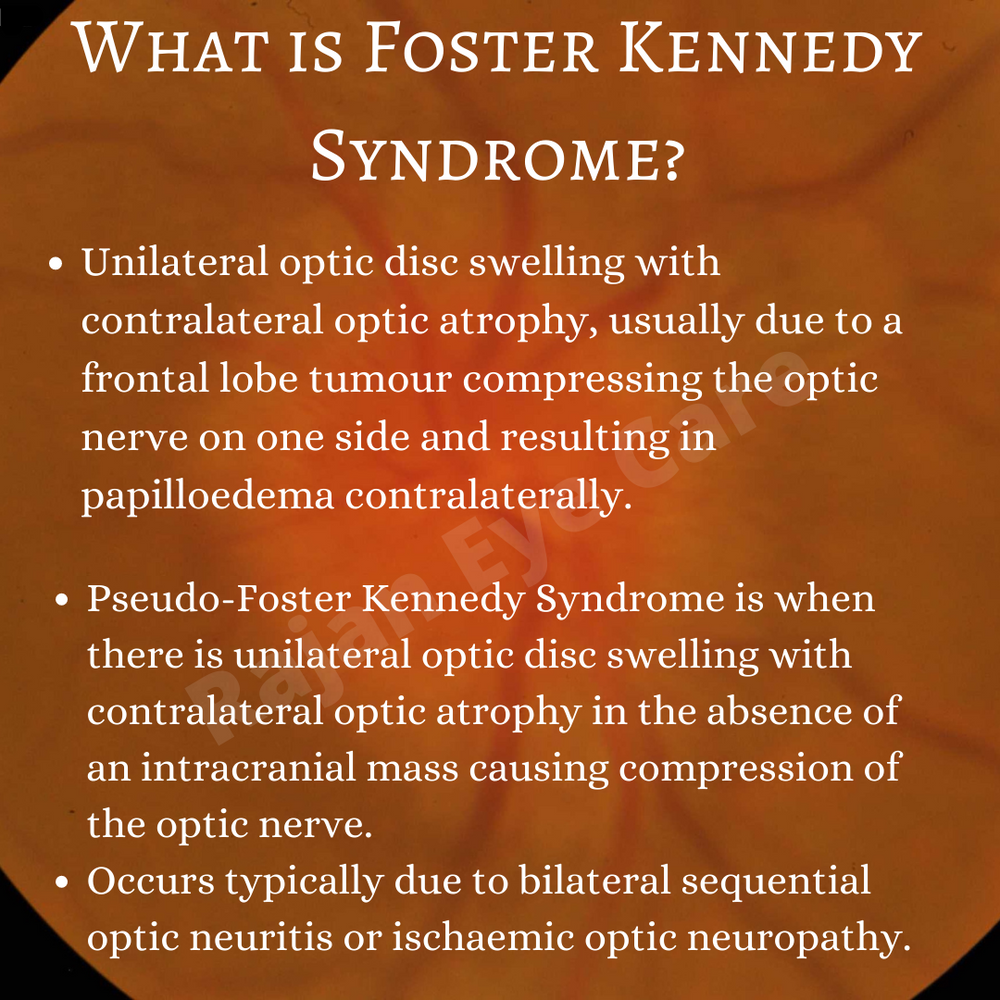 Weekend Bytes What is Foster Kennedy Syndrome?