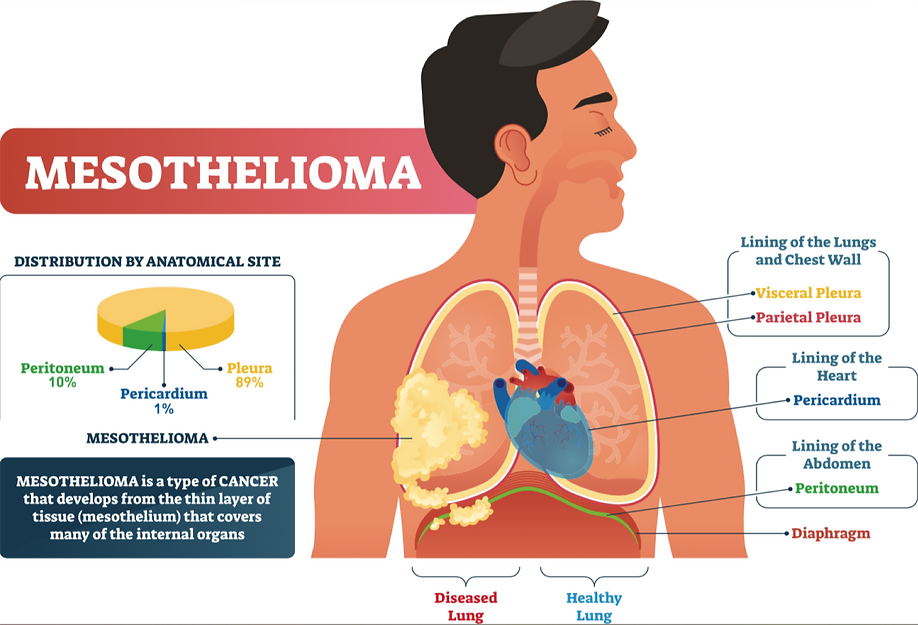 Mesothelioma.webp