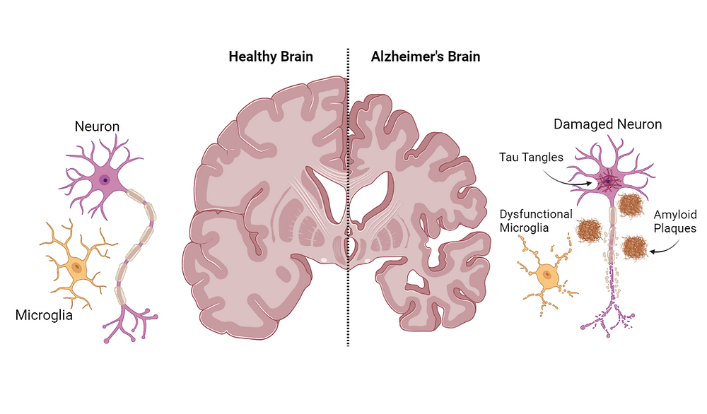 The Role of the Immune Response in Alzheimer’s Disease